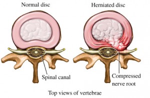 disc hernia 2